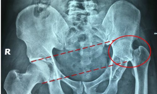 Ngồi bắt chéo chân: lịch lãm hay tai hại?