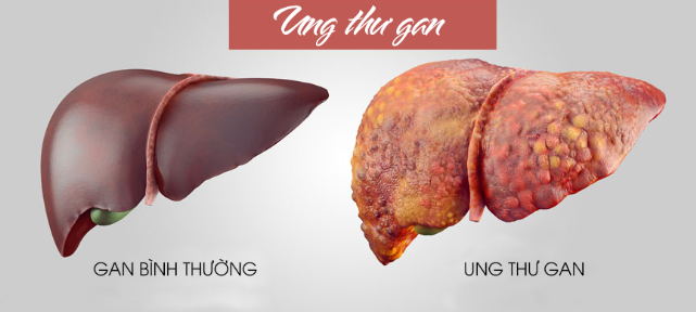 Top 5 bệnh gan có tỷ lệ mắc cao nhất Việt Nam và những biến chứng nguy hiểm nếu không phát hiện kịp thời 