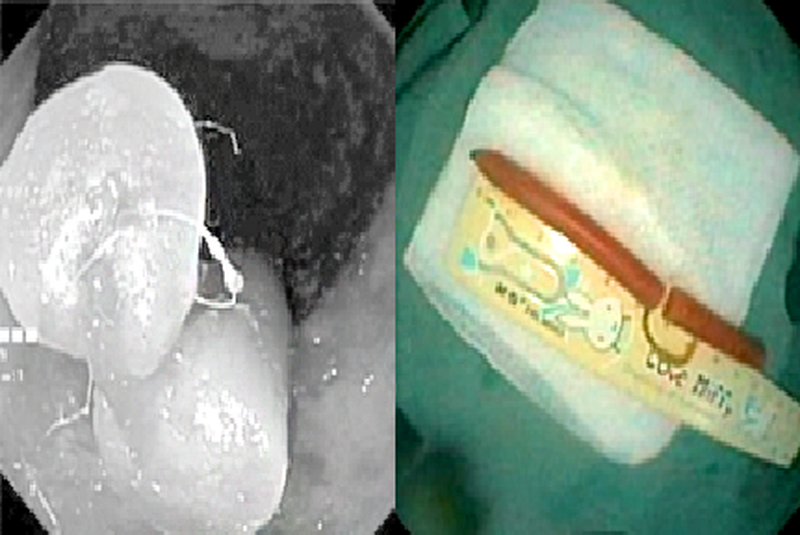 Hi hữu: Gắp cây nến trong trực tràng bé 5 tháng tuổi