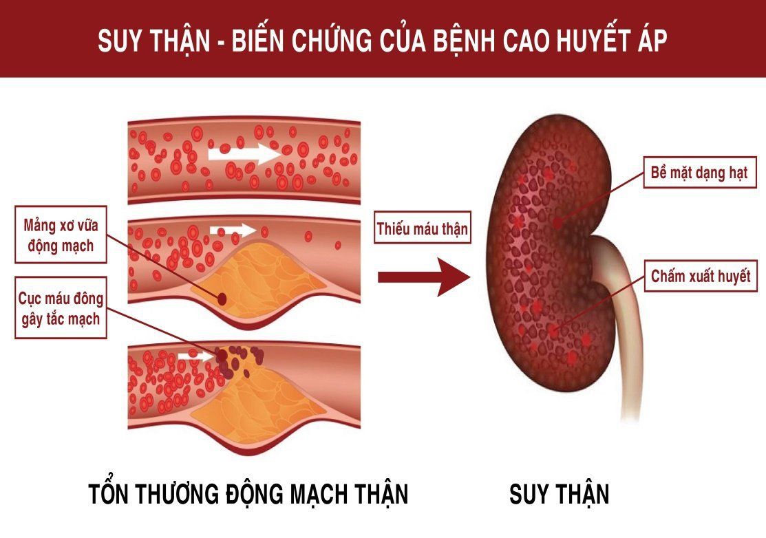 10 cách phòng ngừa suy thận không phải ai cũng biết