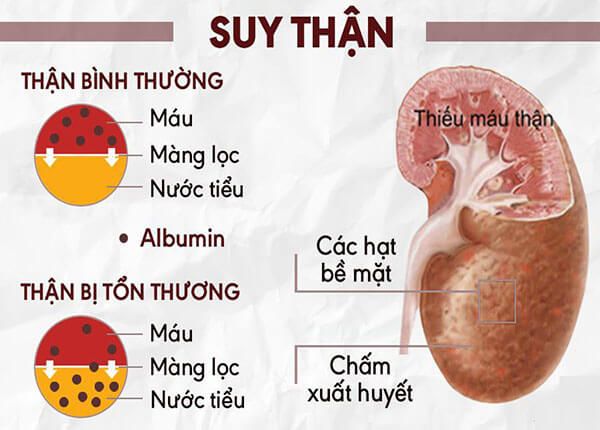 Tại sao tỉ lệ mắc bệnh thận ở nam giới lại nhiều hơn nữ giới?
