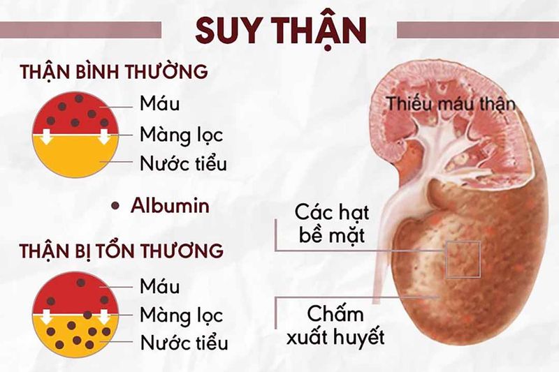 11 nguyên tắc dinh dưỡng quan trọng dành cho người suy thận trước khi chạy thận