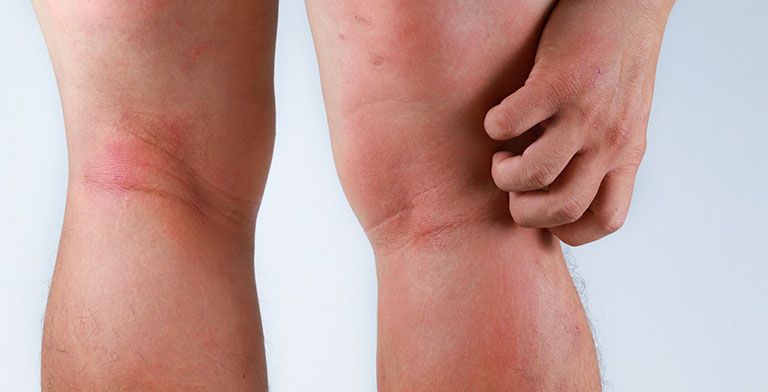 5 dấu hiệu cho thấy thận đã làm việc quá sức, cần được chăm sóc đặc biệt 