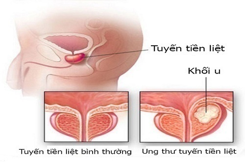 9 bệnh ung thư có tỷ lệ mắc cao nhất, đặc biệt là ở nam giới