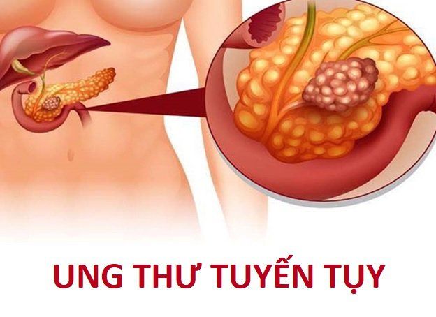 9 bệnh ung thư có tỷ lệ mắc cao nhất, đặc biệt là ở nam giới