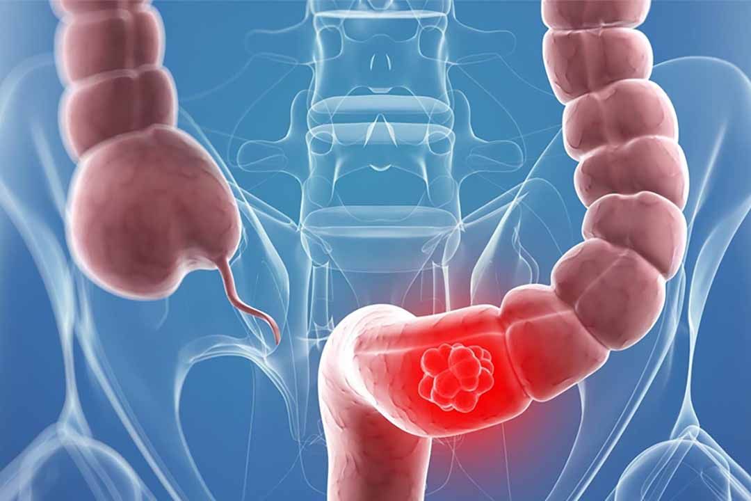 Nếu bạn gặp 10 dấu hiệu dưới đây, nên sớm đi khám ung thư tuyến tiền liệt ngay kẻo muộn 