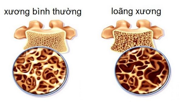 Top 10 bệnh thường gặp ở người cao tuổi và cách phòng tránh. 