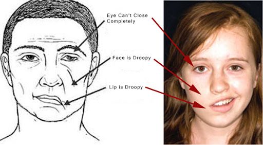 Cẩn thận liệt dây thần kinh số 7 - tai biến do tắm đêm, lạnh đột ngột
