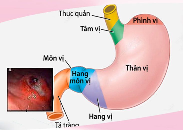 Top 6 bệnh dạ dày thường gặp nhất hiện nay 