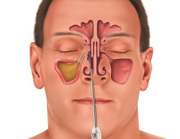 6 bệnh đường hô hấp thường gặp khi thời tiết chuyển lạnh 