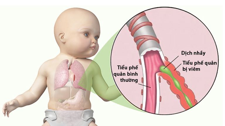 6 bệnh đường hô hấp thường gặp khi thời tiết chuyển lạnh 