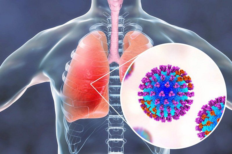 2 di chứng ở phổi nặng nề nhất mà người mắc hội chứng hậu COVID-19 không thể chủ quan