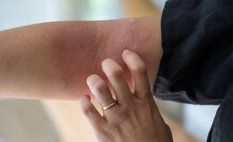 Trời lạnh da khô phải làm sao? 5 cách giúp da mịn màng hơn