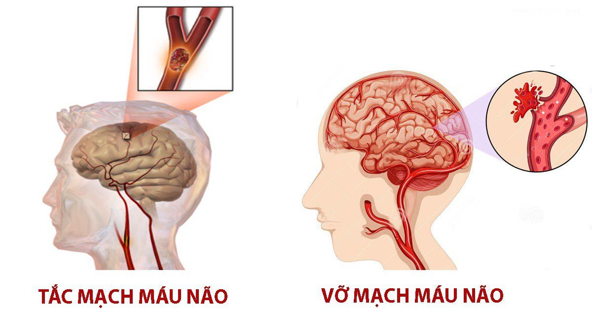 Mỡ máu cao gây tai biến: 4 cách giảm mỡ máu để ngừa rủi ro 