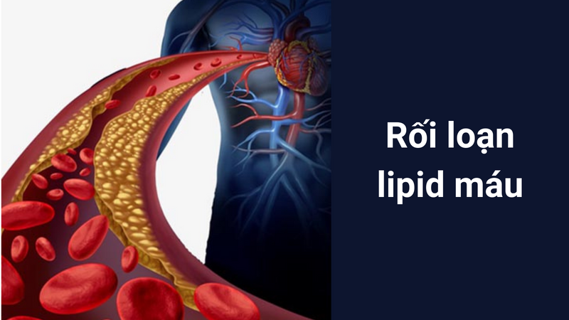 Rối loạn lipid máu và nguy cơ bệnh tim mạch, cần kiểm tra thường xuyên