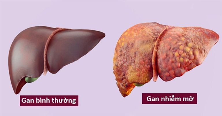 Điểm mặt 8 nguyên nhân phổ biến khiến men gan tăng cao cần kiểm tra ngay