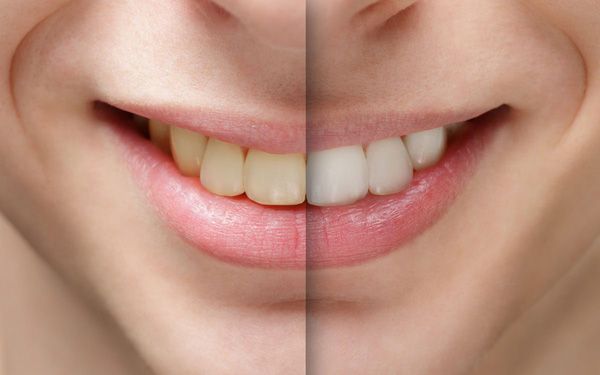 "Điểm mặt" 8 thói quen sai lầm là nguyên nhân khiến răng bị ố vàng 