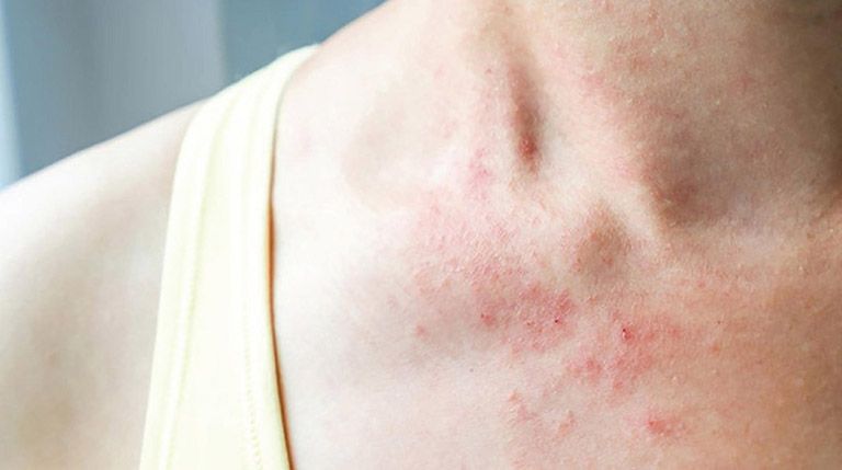 Cách phòng tránh những căn bệnh thường gặp vào dịp Tết 