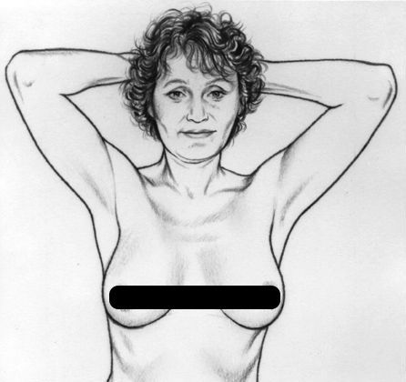 5 động tác nhìn, sờ, nắn vòng 1 kiểm tra ung thư vú