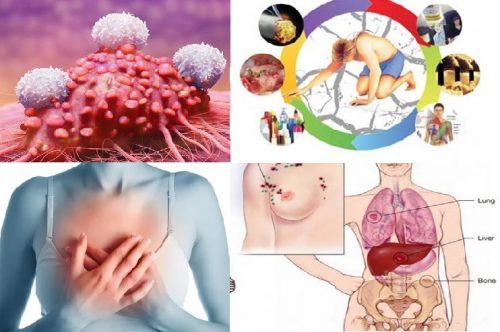 5 động tác nhìn, sờ, nắn vòng 1 kiểm tra ung thư vú