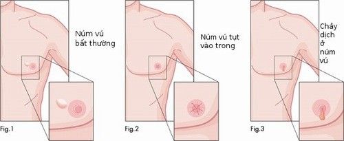 Đừng chủ quan với căn bệnh ung thư vú ở nam giới, hậu quả khôn lường. Xem ngay để biết dấu hiệu 
