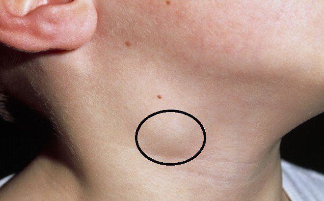 Tỷ lệ chữa khỏi ung thư vòm họng theo từng giai đoạn 