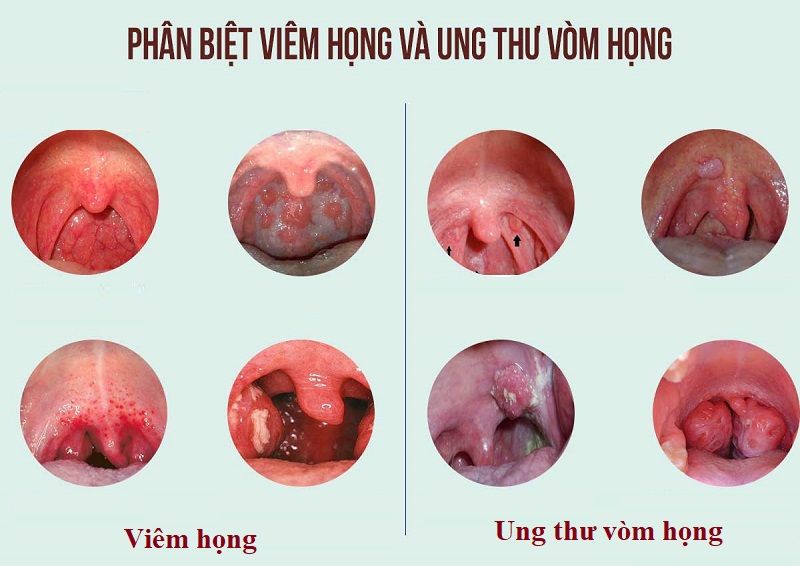 Cách phân biệt ung thư vòm họng và viêm họng nhanh và chính xác nhất