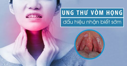 Cách phân biệt ung thư vòm họng và viêm họng nhanh và chính xác nhất