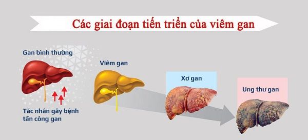 Điều trị hiệu quả căn bệnh thế kỷ - ung thư bằng cách hiểu đúng về các giai đoạn của nó