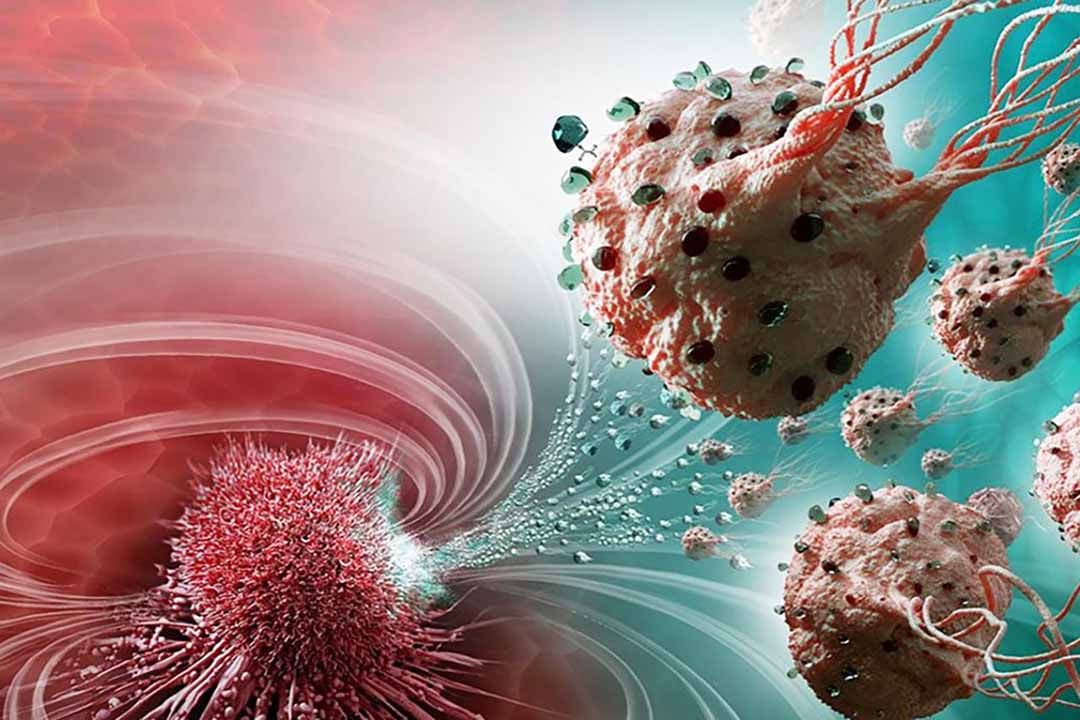 Điều trị hiệu quả căn bệnh thế kỷ - ung thư bằng cách hiểu đúng về các giai đoạn của nó