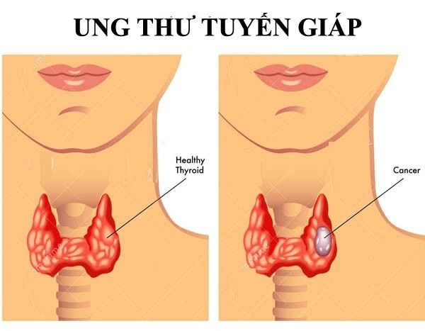 Lưu ý phân biệt ung thư tuyến giáp và ung thư vòm họng 