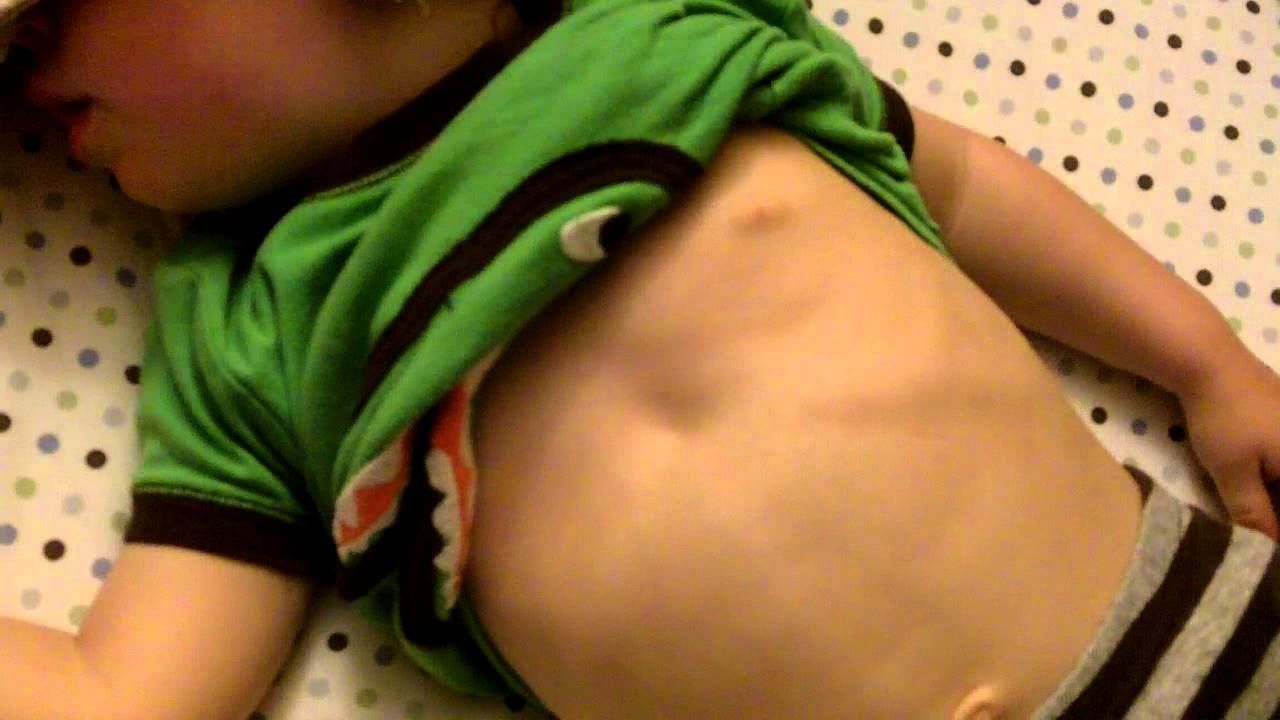 Dấu hiệu trẻ F0 chuyển nặng cần nhập viện