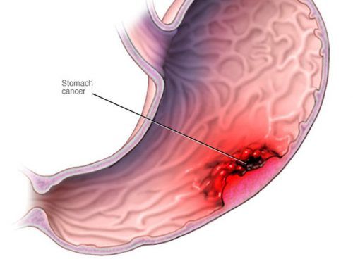 Dấu hiệu nhận biết ung thư dạ dày giai đoạn đầu