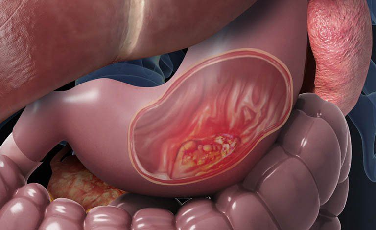 4 giai đoạn phát triển và di căn của bệnh Ung thư dạ dày