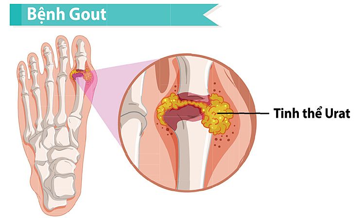 6 thói quen tưởng chừng vô hại nhưng lại là nguyên nhân chính dẫn đến bệnh gout (gút)