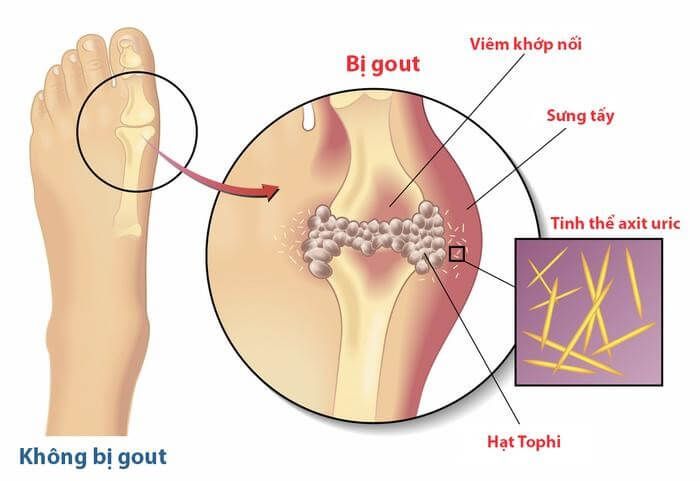 Xét nghiệm Gout giúp phát hiện điều trị bệnh Gout kịp thời