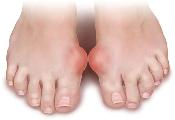 Xét nghiệm Gout giúp phát hiện điều trị bệnh Gout kịp thời