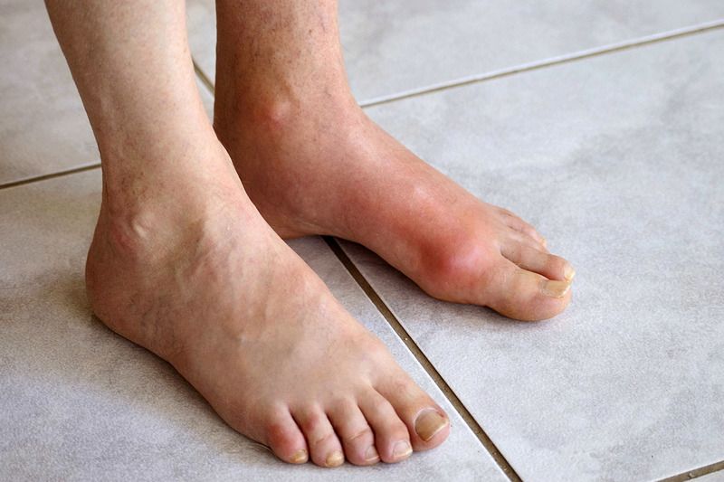 Dấu hiệu cảnh báo bạn bị bệnh gout