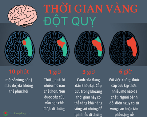 Đột quỵ ở trẻ: Nguyên nhân, dấu hiệu và các biện pháp phòng ngừa