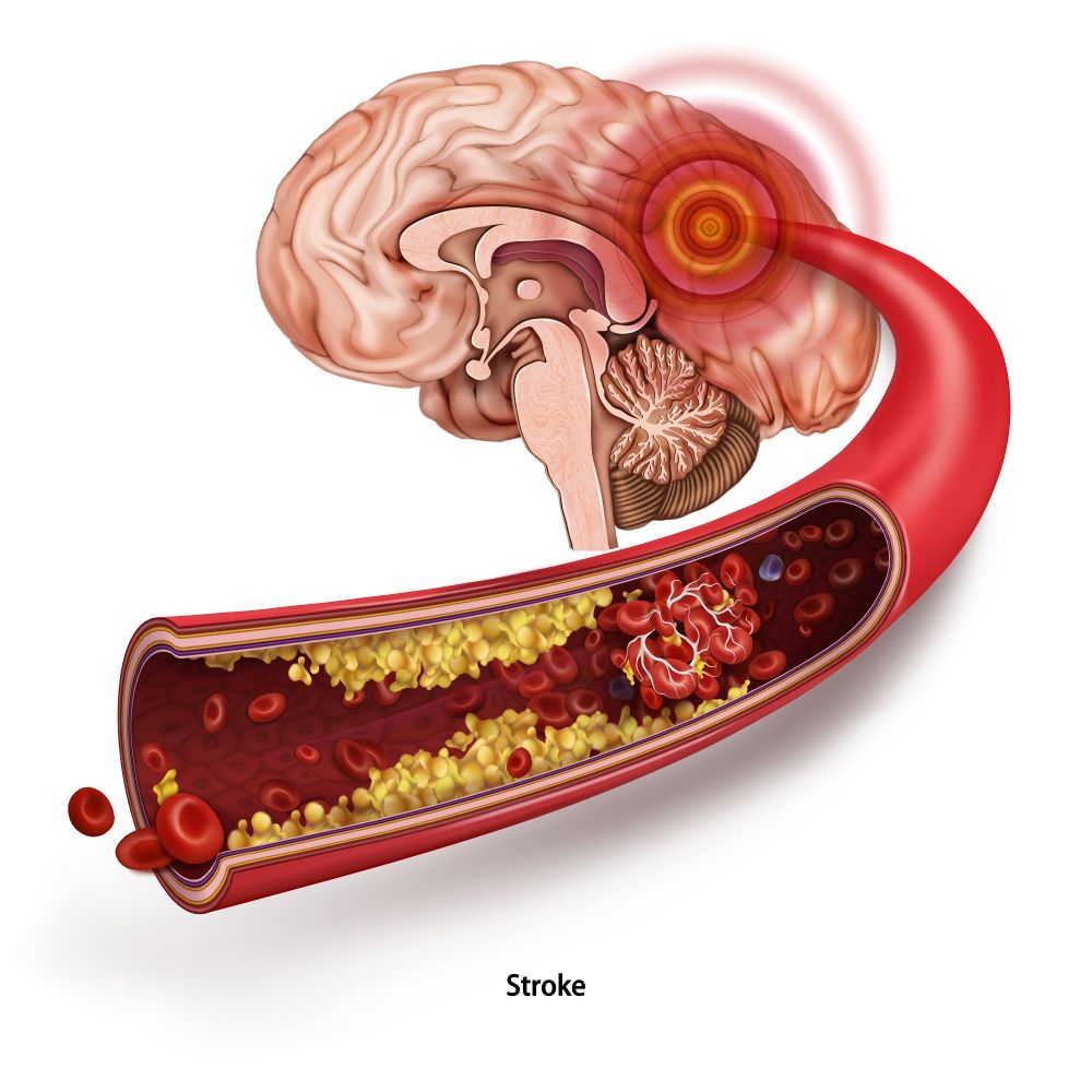 Cục máu đông - thủ phạm gây đột quỵ hậu Covid-19