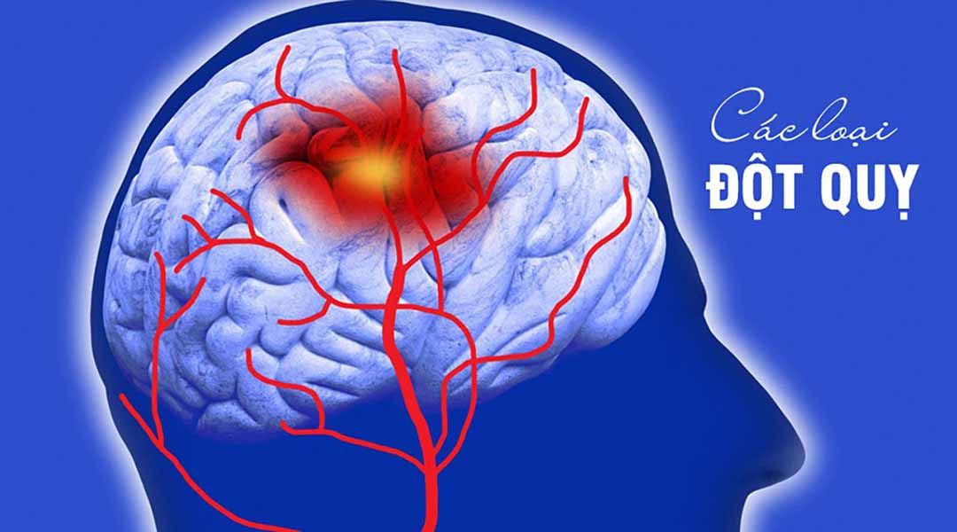 “Giờ vàng” giúp bệnh nhân đột quỵ thoát hiểm