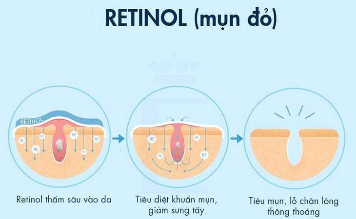Retinol là gì? Cách dùng retinol trị mụn, chống lão hóa da