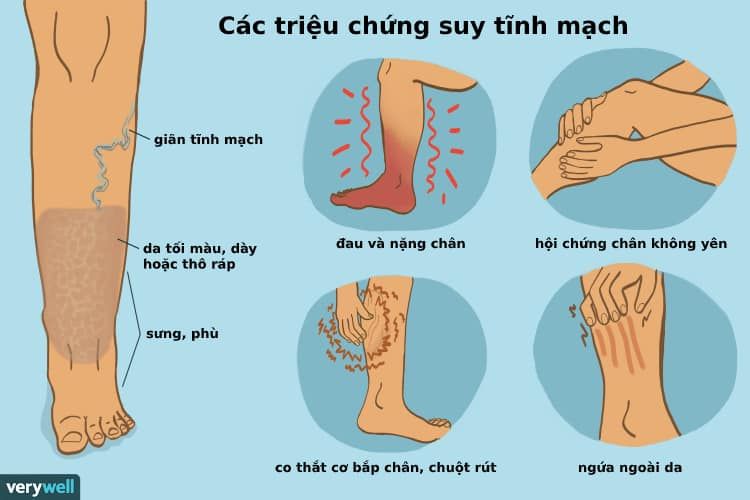 Các triệu chứng suy giãn tĩnh mạch chân mà bạn nên biết