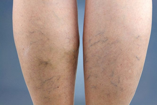 Nguyên nhân không ngờ khiến bạn bị suy giãn tĩnh mạch chân mà không biết