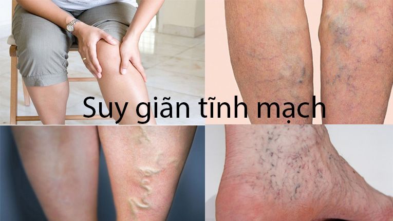 9 cách trị giãn tĩnh mạch chân tại nhà an toàn và hiệu quả