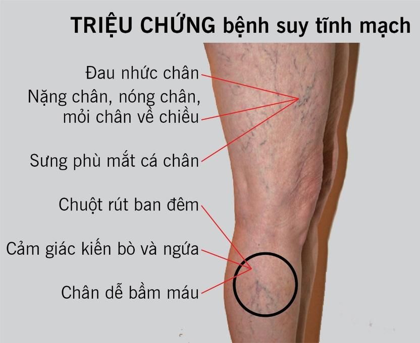 Bệnh suy giãn tĩnh mạch chân có nguy hiểm hay không?