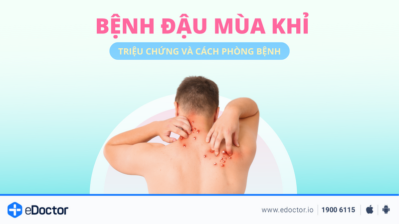 Bệnh đậu mùa khỉ: Triệu chứng và cách phòng bệnh