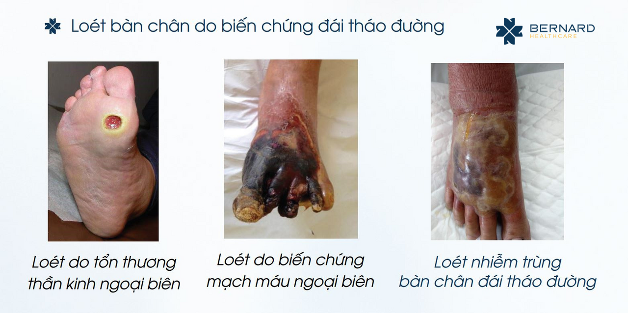 Bị loét bàn chân lâu không lành, khám ở đâu?