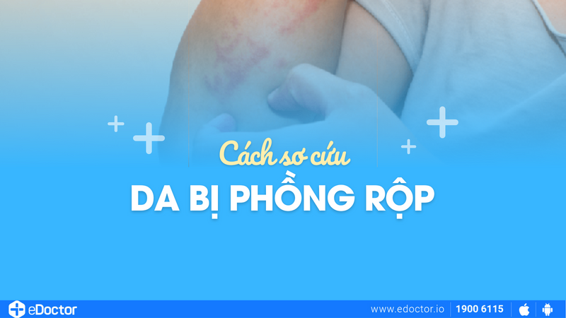 Cách sơ cứu da bị phồng rộp