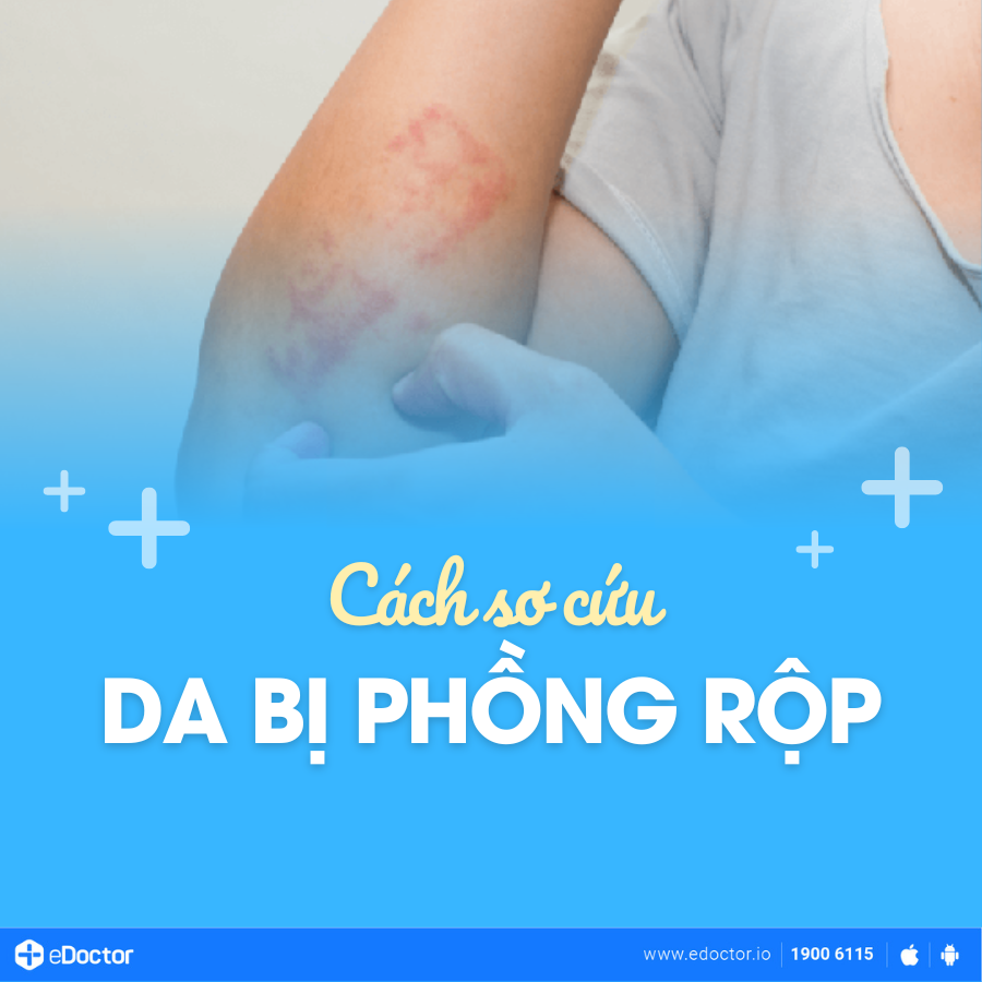 Cách sơ cứu da bị phồng rộp